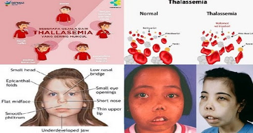 Bệnh tan máu bẩm sinh "thalassemia"